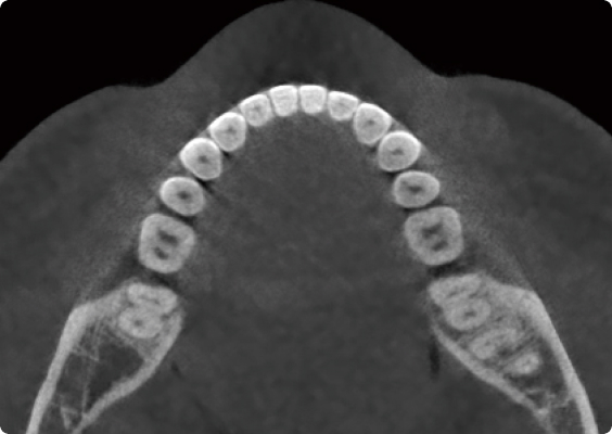 Before beam hardening artifact reduction